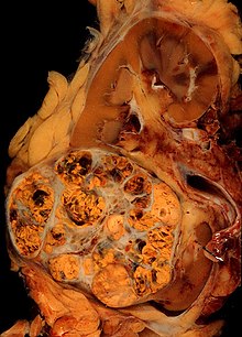 Renal cell carcinoma